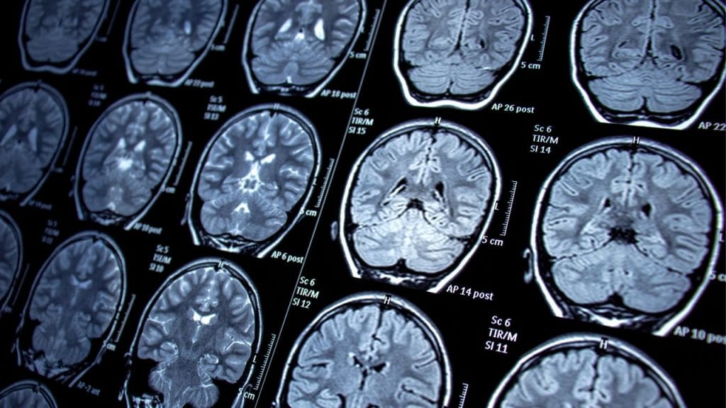 Neurological disorders finding relief through medical cannabis